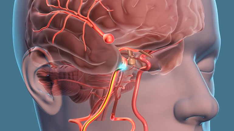 How to Prevent a Brain Aneurysm: Risk Factors and Lifestyle Changes
